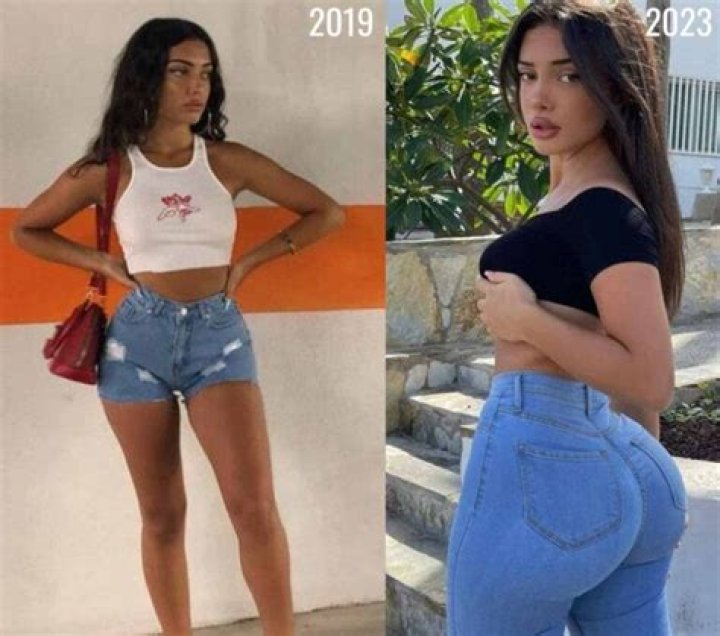 Melimtx Before Surgery | Plastic Surgery Transformation