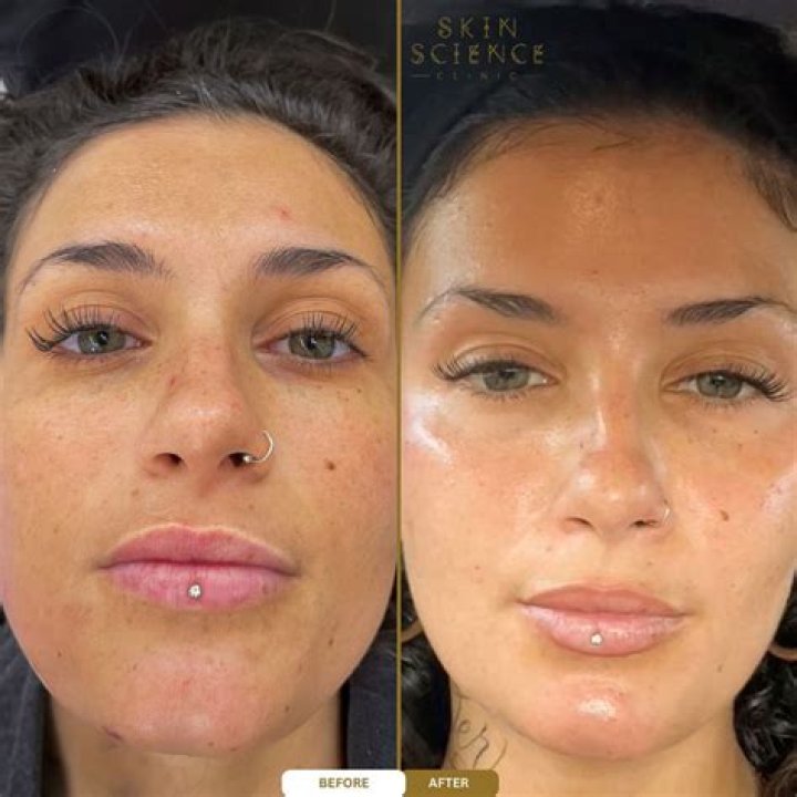 Nazanin Kavari Before And After Photos | BBL And Nose Job