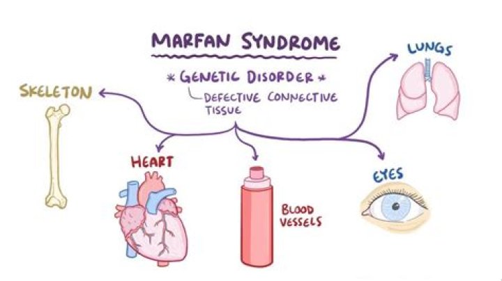 What Happened To Marfan Mike? Coma Survivor Death Cause, Marfan Syndrome Update